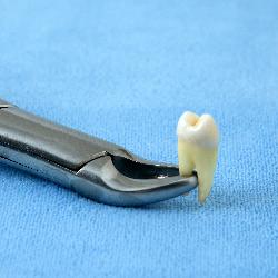 Zahn ziehen als Alternative zur Wurzelbehandlung
