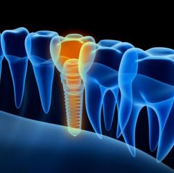 Digitale Aufnahme eines Zahnimplantats