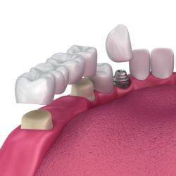 Zahnbrücke und Zahnimplantat im Unterkiefer