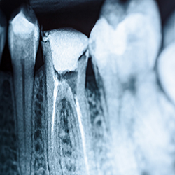 Röntgenbild von Zahnwurzel am Leuchtkasten
