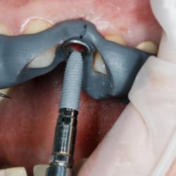 Zahnimplantat wird mithilfe einer Bohrschablone gesetzt