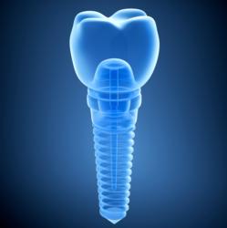 Zahnimplantat digitales Röntgen