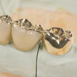 Zahnbrücke aus Gold auf Modell