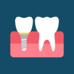 Grafik eines Zahns und eines Zahnimplantats auf dunkelblauem Hintergrund