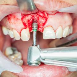 Zahn Implantation mit Knochenfreilegung