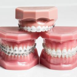 Modelle mit verschiedenen Arten von Zahnspangen