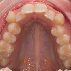 Zahnfehlstellung im oberen Frontzahnbereich