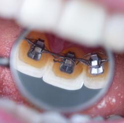 Nachaufnahme Brackets auf Innenseite der Zähne