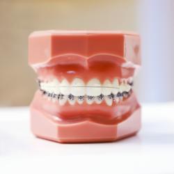 Modell mit zwei verschiedenen Zahnspangen Metall und transparent