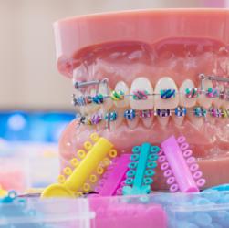 Modell einer festen Zahnspange mit bunten Gummibändern