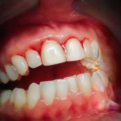 Parodontose Zahnfleischbluten