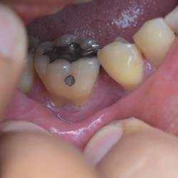 Parodontose Zahnfleischrückgang