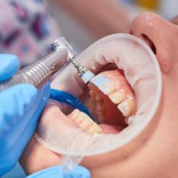 In Vorbereitung auf die Komplettsanierung wird eine professionelle Zahnreinigung durchgeführt.