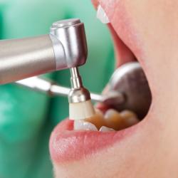 Zahnpolitur bei der Professionellen Zahnreinigung