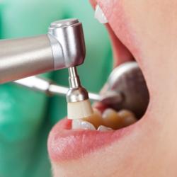Professionelle Zahnreinigung in der Zahnarztpraxis