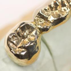Zahnbrücke aus Gold auf Gipsmodell