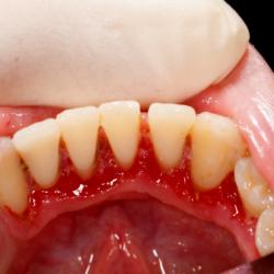 Parodontitis Behandlung Zahnfleischrückgang