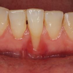 Parodontitis Zahnfleischrückgang freiliegender Zahnhals