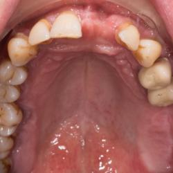 Erwachsenes Gebiss mit Parodontitis und Zahnverlust