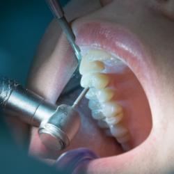 Reinigung der Zähne beim Zahnarzt