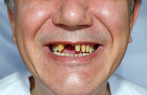 Mann ohne zähne
