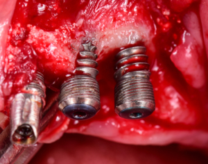 Entzündung am Zahnimplantat = Periimplantitis