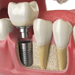 Implantat neben natürlichen Zähnen im Querschnitt