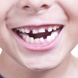 Lächelnder Kindermund mit schiefen Zähnen und Lücken